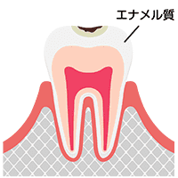 軽度のむし歯