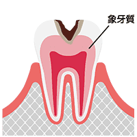 中度のむし歯