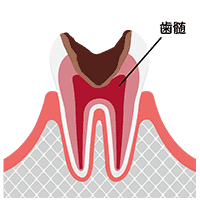 重度のむし歯