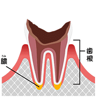 最重度のむし歯