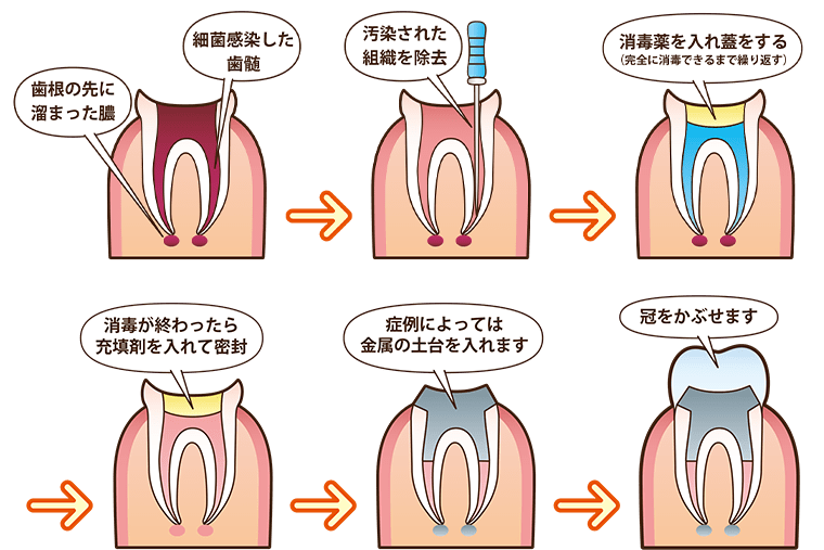 根管治療