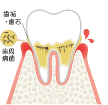 歯周病