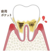 歯周炎（軽度）