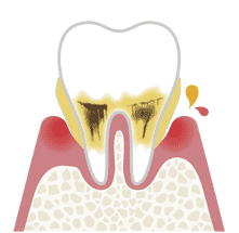 歯周炎（中度）