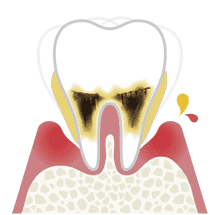 歯周炎（重度）