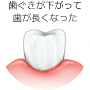 歯ぐきが下がって歯が長くなった