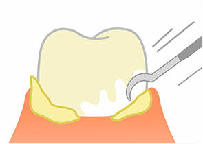 歯周ポケットに潜む歯石を除去できます